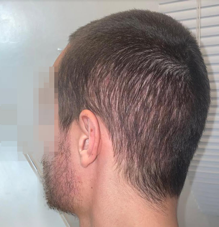 hair transplant black market clinic 1