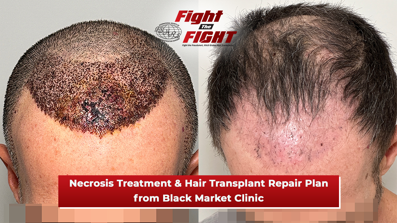 necrosis from black market hair transplant clinic wide