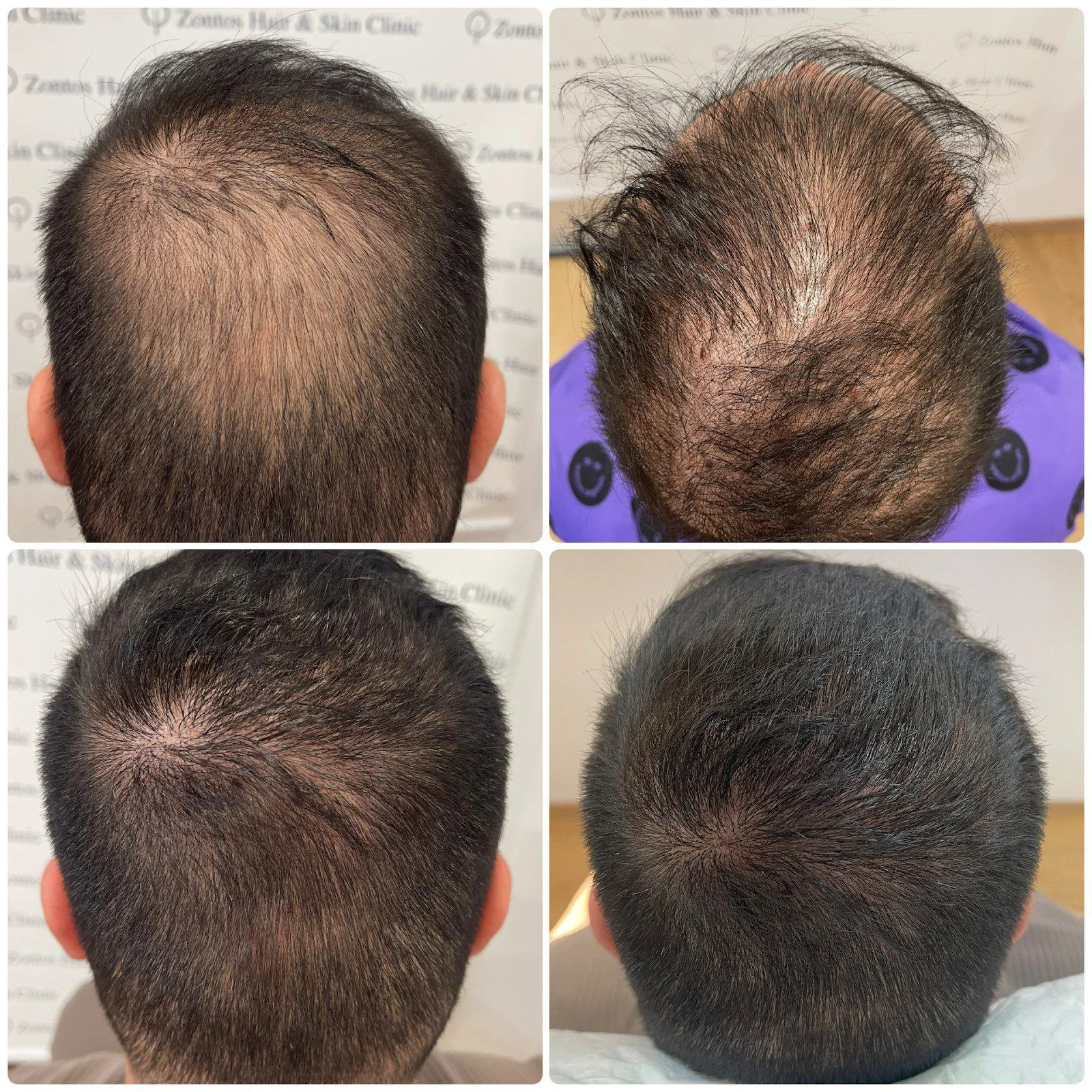 Images showing hair density increasing in a year.